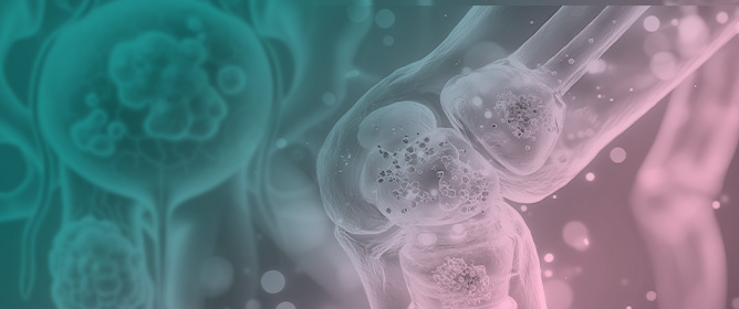 Testing for Causal Association Between Serum Urate, Gout, and Prostatic Cancer in European Males