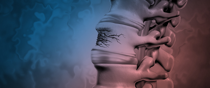 Anterior Column Reconstruction of the Thoracolumbar Spine with a Modular Carbon-PEEK Vertebral Body Replacement Device: Single-Center Retrospective Case Series of 28 Patients