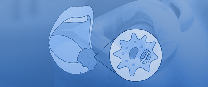 Ferroptosis and Oral Cancer Therapy