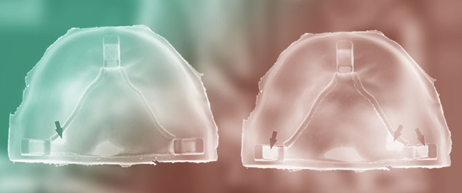 Effect of Framework Orientation at a Selective Laser Melting Building Platform on Removable Partial Denture Fit