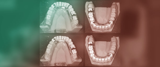 Forces Transmitted to Abutment Teeth in Distal Extension Removable Partial Denture&mdash;Impact of Indirect Retention