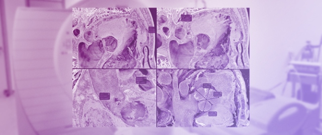 Reliability of Immersive Virtual Reality for Pre-Procedural Planning for TAVI: A CT-Based Validation