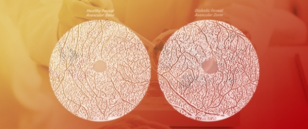 Quantitative Analysis of Different Foveal Avascular Zone Metrics in Healthy and Diabetic Subjects
