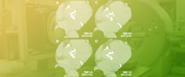 Virtual Non Contrast Photon Counting CT for Aortic Valve Calcium Scoring