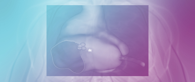 Atrioventricular Junction Ablation with High-Definition Recording of Atrioventricular Node Potential