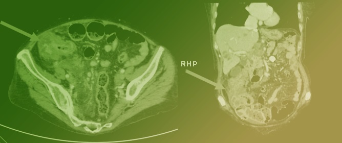 Prediction of Microsatellite Instability in Colorectal Cancer Using Two Internally Validated Radiomic Models