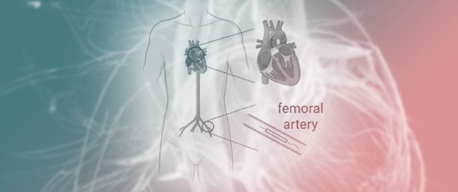 Evaluation of the Effect of Transcatheter Aortic Valve Implantation in Patients with Severe Aortic Stenosis on the Concentration of the Fatty Acids Involved in Inflammation