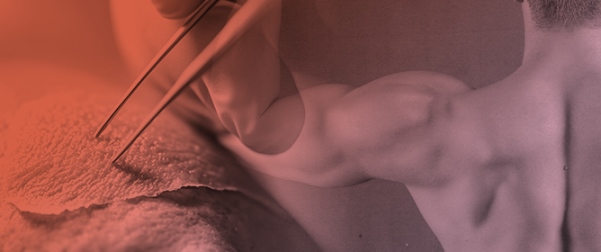 Long-Term Cosmetic Outcomes of Modified CEA on a Bodybuilder&rsquo;s Burn Wounds