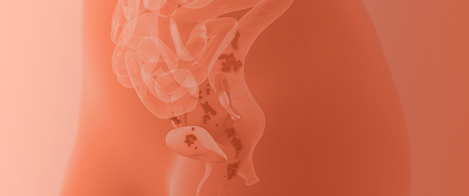 When the Body Hurts, the Mind Suffers: Endometriosis and Mental Health