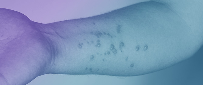 Dynamic Analysis and Optimal Prevention Strategies for Monkeypox Spread Modeled via the Mittag&ndash;Leffler Kernel