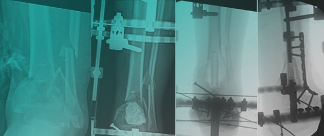 Management Strategies for Failed Pilon Fractures: A Personalized Approach to Revision Reconstruction