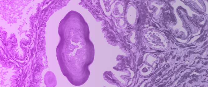 Molecular and Genetic Biomarkers in Prostate Cancer Active Surveillance: Recent Developments and Future Perspectives