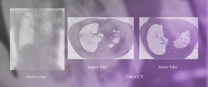 Two Clinical Cases Showing High Efficacy at Low Doses Using the New Drug Delivery System ALIS for Refractory Pulmonary Mac Disease