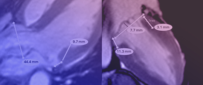 Genetic Variants as a Potentially Arrhythmogenic Substrate in Mitral Annular Disjunction: Case Report and a Systematic Review of the Literature