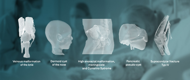 Use of Patient-Specific 3D Models in Paediatric Surgery: Effect on Communication and Surgical Management