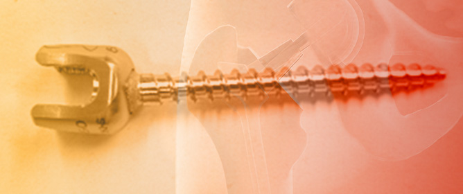 Bactericidal Titanium Oxide Nanopillars for Intersomatic Spine Screws