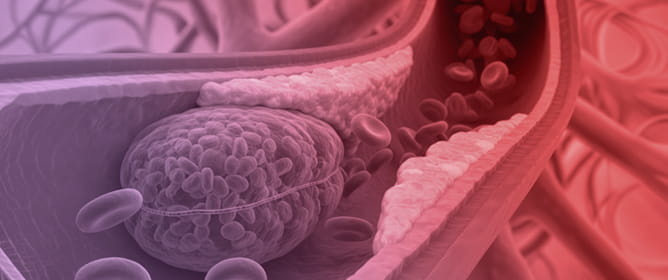 Persistent Remission of Angioimmunoblastic T-Cell Lymphoma and Associated Immune-Mediated Thrombotic Thrombocytopenic Purpura After Multimodal Therapy: A Case Report