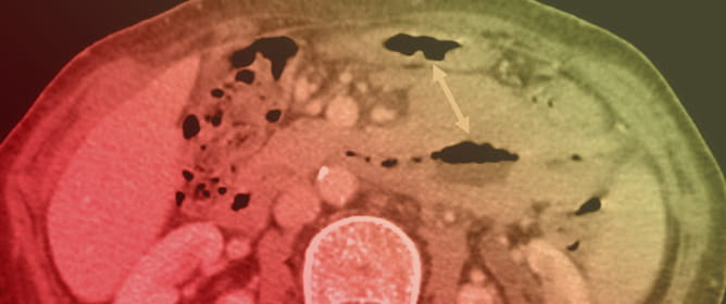 Primary Small Bowel MALT Lymphoma with Concurrent Pulmonary Dissemination: A Case Report
