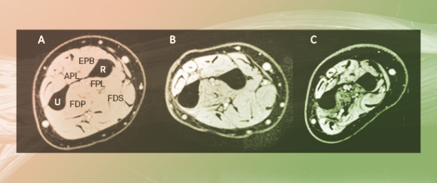 Quantitative Magnetic Resonance Imaging of the Forearm in Myotonic Dystrophy Type 1