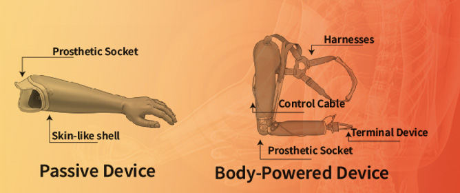 The Technological and Psychological Aspects of Upper Limb Prostheses Abandonment: A Narrative Review