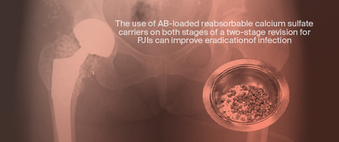Calcium Sulfate Carriers Impact on Periprosthetic Joint Infections&rsquo; Management