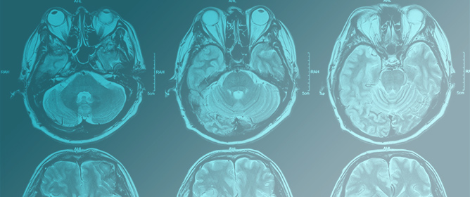 Cerebello-Pontine Angle Tumors in Children: An Update on Challenging Neoplasms