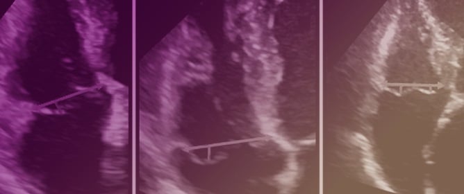 Prevalence and Importance of Tricuspid Valve Prolapse in Patients with Primary Mitral Regurgitation