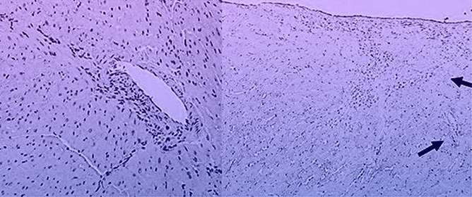 Autoimmune Myocarditis in Diversity Outbred Mice