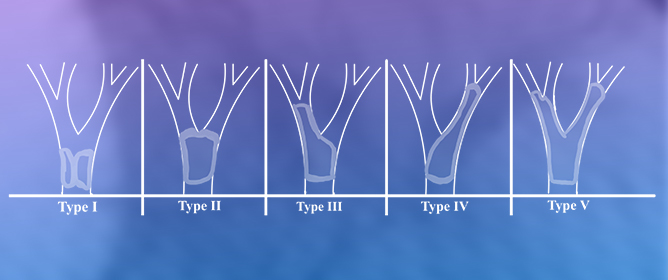 Radiofrequency Ablation (RFA) with Biliary Stenting in Malignant Biliary Obstruction: Case Series from a Single-Institution