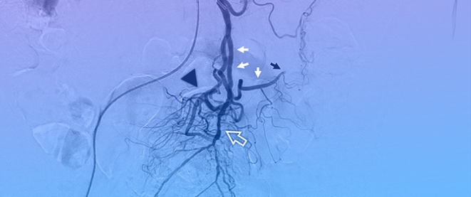 Arteriovenous Malformations and Fistulas of the Inferior Mesenteric Artery: A Comprehensive Literature Review and Clinical Experience