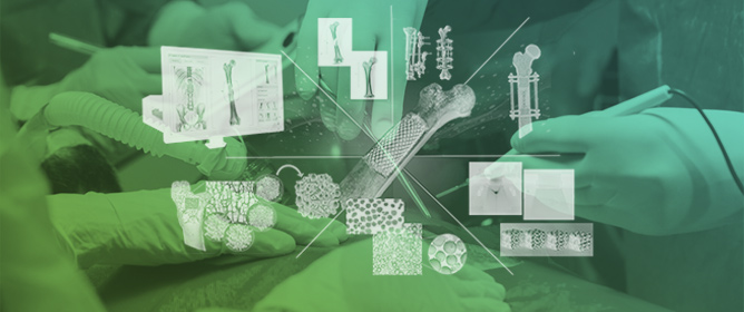 Patient-Specific Lattice Implants for Segmental Femoral and Tibial Reconstruction (Part 1): Defect Patterns, Fixation Strategies and Reconstruction Options&mdash;A Review