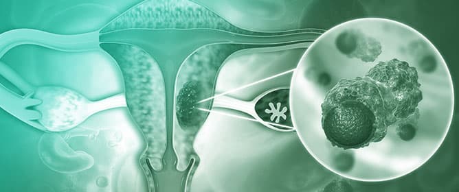 Chemiluminescent Biosensor Utilizing Magnetic Particles for the Detection of Ovarian Cancer Biomarker Lysophosphatidic Acid