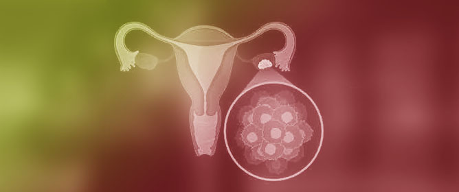 Patient-Derived Microtumors: How Can We Continue to Personalize Treatment for Ovarian Cancer Patients?