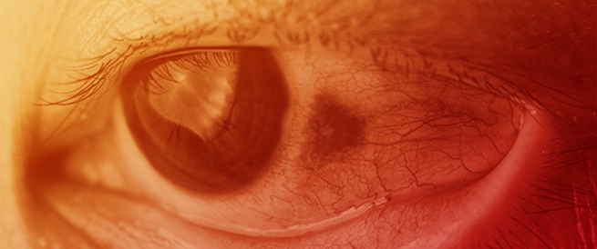 Multiple Sclerosis-Associated Uveitis Therapy: Is Modern Better than Old Reliable?