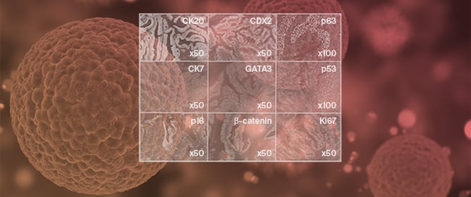 Urachal Carcinoma with Divergent Glandular Enteric-Type and Squamous Differentiation Associated with Bladder Exstrophy: Case Report of an Extremely Rare Entity