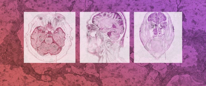 Diagnostic Challenge of Extranodal Marginal Zone Lymphoma of Extraocular Muscles: A Case Report