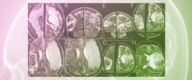 Diffusion Tensor Imaging and Advanced Diffusion Imaging in Post-Stroke Aphasia Recovery