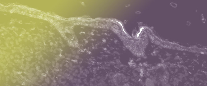 Evaluation of Anti-dsDNA Antibodies in Laboratory Practice: Management of Different Analytical Methods and Correlation with HEp-2 Immunofluorescence Patterns