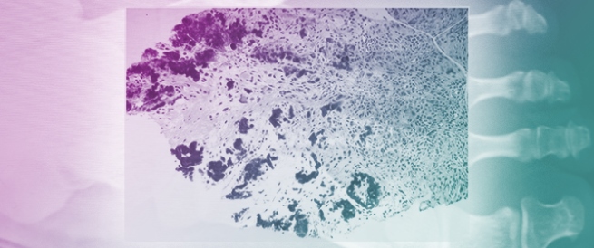 The Utility of Ultrasound-Guided Synovial Biopsy in the Diagnosis of Crystal-Induced Arthritis