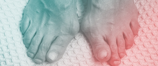 Irregular Gout, Asymptomatic Hyperuricaemia and the Role of Treatment