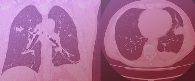 Friend or Foe? Eosinophilic Granulomatosis with Polyangiitis (EGPA) Onset After Dupilumab: Report of Two Cases and a Narrative Review of the Literature