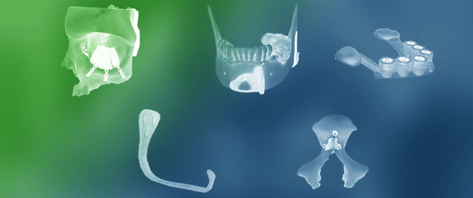 Academic Point-of-Care Manufacturing in Oral and Maxillofacial Surgery: A Retrospective Review at Gregorio Mara&ntilde;&oacute;n University Hospital