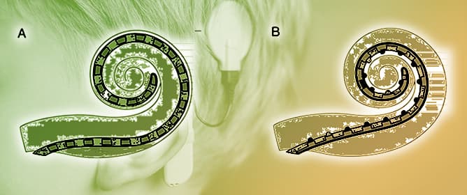 Comparing Slim Straight and Slim Perimodiolar Electrode Arrays for Cochlear Implantation