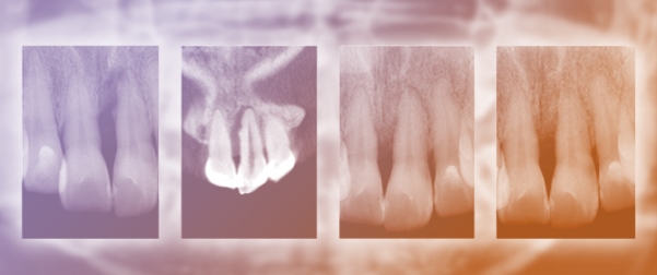 A Clinical Framework for Interpreting Endodontic&ndash;Periodontal Lesions