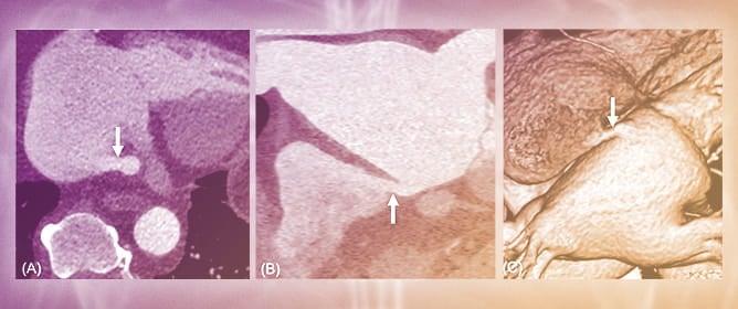 Inferior Left Atrial Diverticulum Communicating with the Right Atrium or Inferior Vena Cava: Prevalence and CT Features
