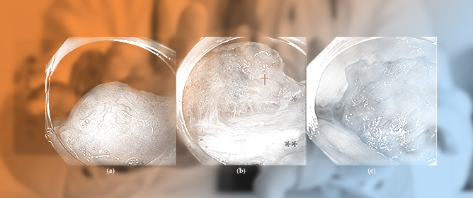 Endoscopic and Hybrid Approaches for Gastric Subepithelial Tumors: Expanding the Frontiers of Minimally Invasive Therapy