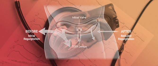 Transcatheter Edge-to-Edge Repair for Mitral Regurgitation: Distinct Interventional Paradigms for Primary and Secondary MR