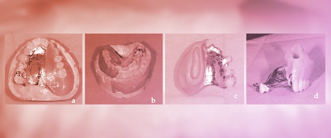 Surgical Procedures to Improve Prosthetic Prognosis After Maxillectomy: A Case Report