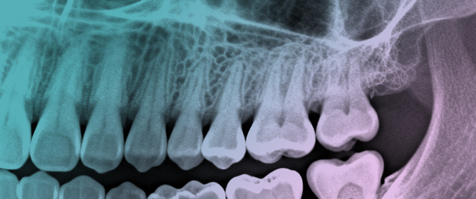 Bone Regeneration After Maxillary Sinus Augmentation with Allogeneic and Xenogeneic Biomaterials with Adjunctive Photobiomodulation: Histological and Radiological Secondary Outcomes of a Randomized Clinical Trial