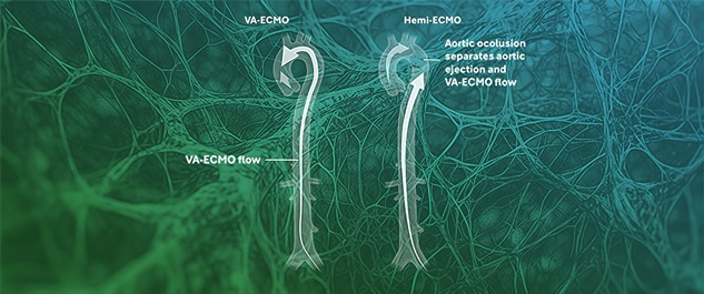 Hemi-ECMO: A Novel Method of Left Ventricular Afterload Reduction for Venoarterial Extracorporeal Membrane Oxygenation (VA-ECMO)